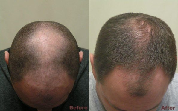 hair-loss-treatment-before-after-top-view-123a75b-big