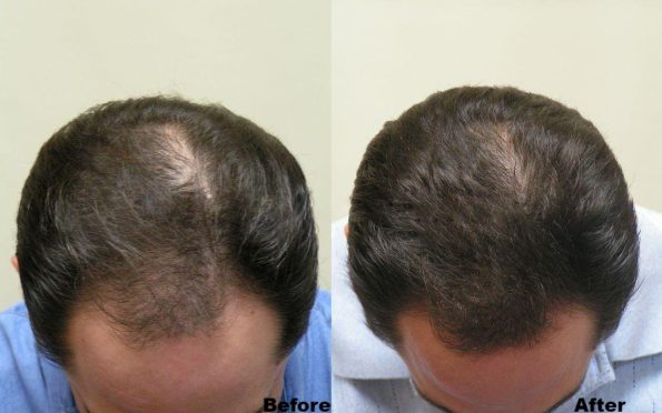 hair-loss-treatment-before-after-top-view-3d41ebb-big