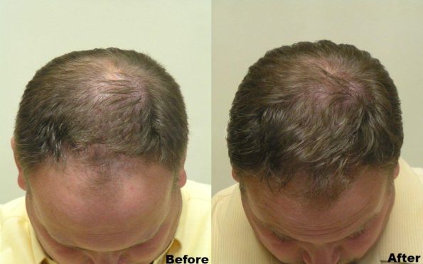hair-loss-treatment-before-after-top-view-b38cba6-big